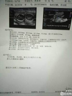 胎儿左侧脉络丛囊肿