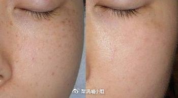 水光针和光子嫩肤哪个好