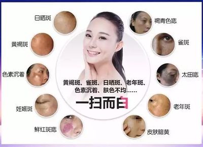 祛斑有什么副作用