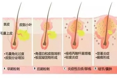 痘痘和粉刺怎么区分