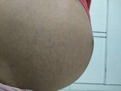 怀孕没有妊娠纹