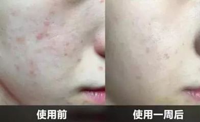 痘好了变成白色痘印