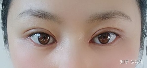 全切双眼皮忌口