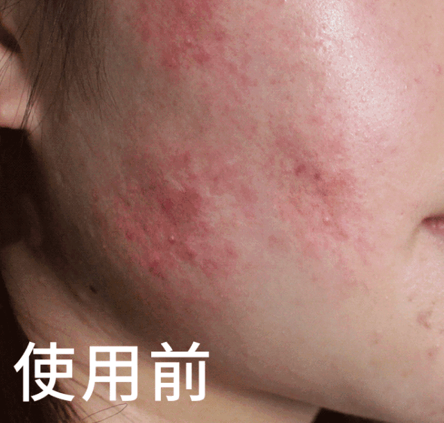 痘痘肌到底用不用面霜
