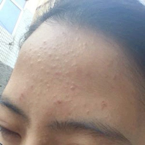 粉刺能用手挤吗