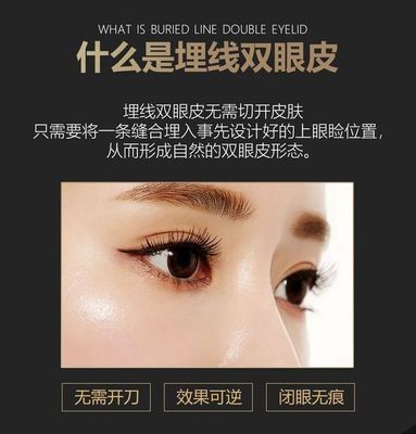 曲靖埋线双眼皮