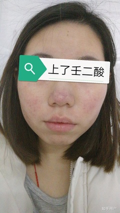 脸部起痤疮如何治