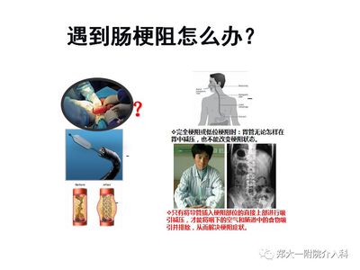 胃梗阻怎么治疗