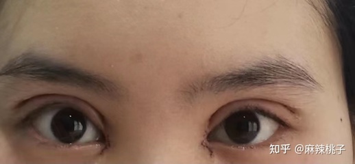 沈阳 双眼皮