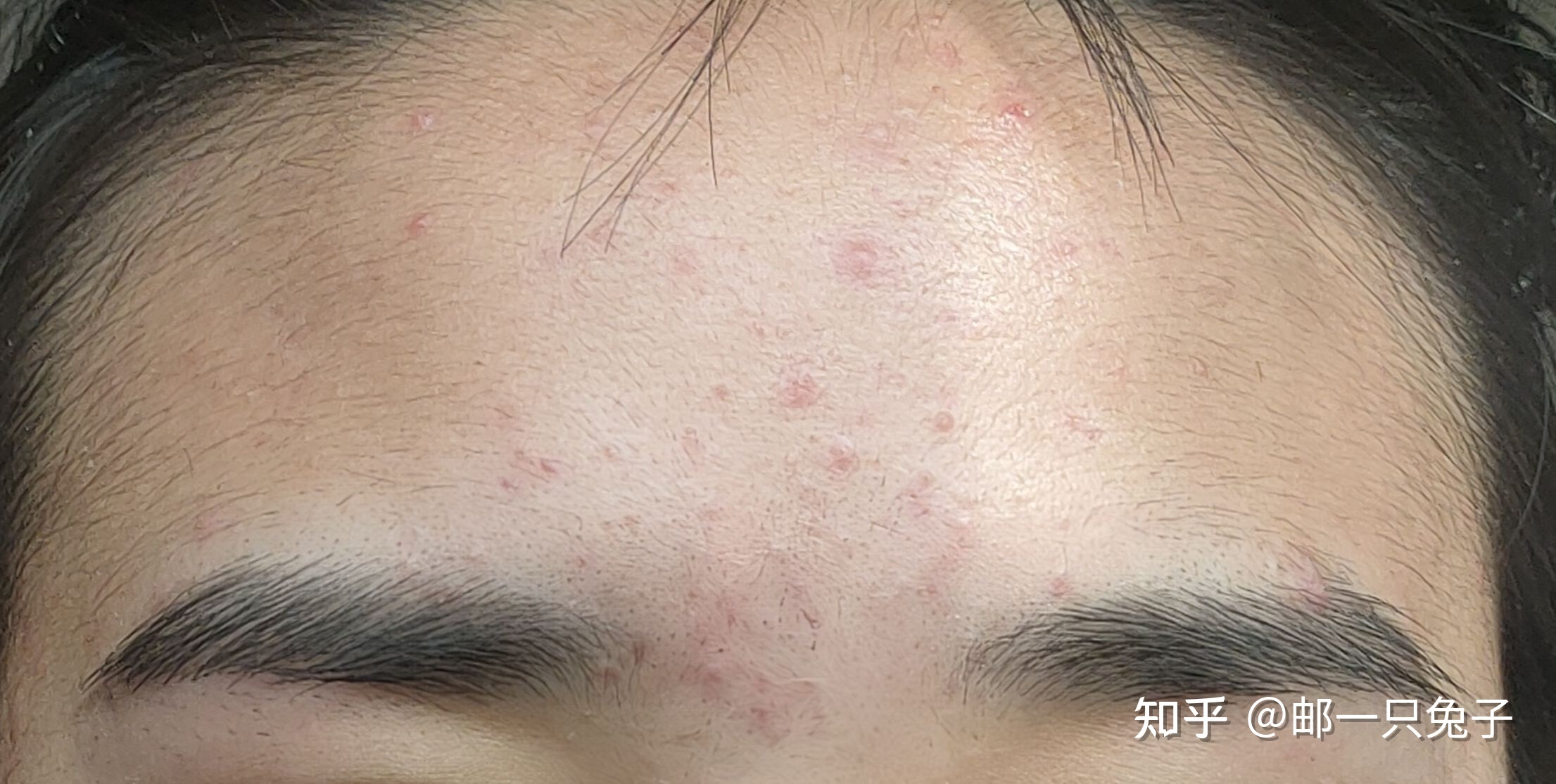 额头长闭口痘痘是什么原因