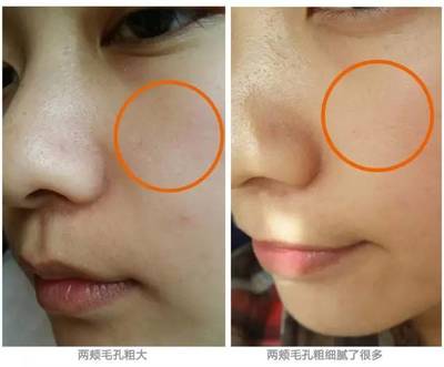 如何使毛孔变细腻