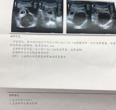 怀孕卵巢囊肿怎么办