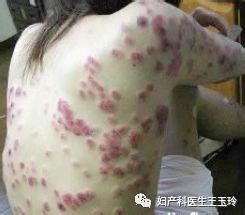 身上有皮疹是怎么回事