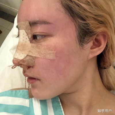 杭州医院隆鼻手术多少钱