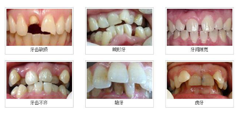 什么情况下做烤瓷牙