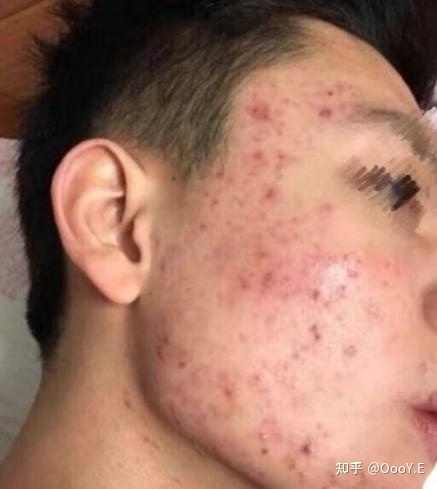 男生经常长痘痘