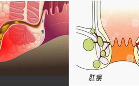 怎么治疗肛裂