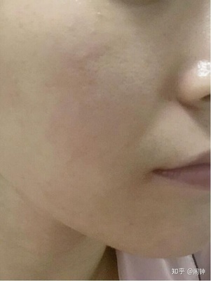 脸上痘痘怎么内调
