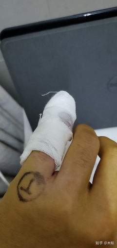 手指肌腱断裂工伤十级