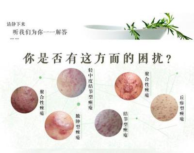 鸡蛋珍珠粉能去痘痘吗