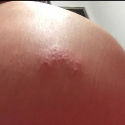 最疼的痘痘