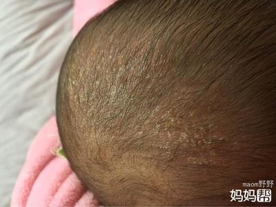 宝宝头皮上有结痂是怎么回事
