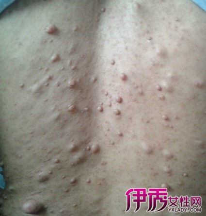 脂囊瘤怎么治疗