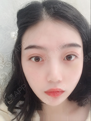 全切双眼皮拆线后