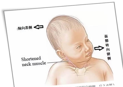 宝宝脖子歪挂什么科