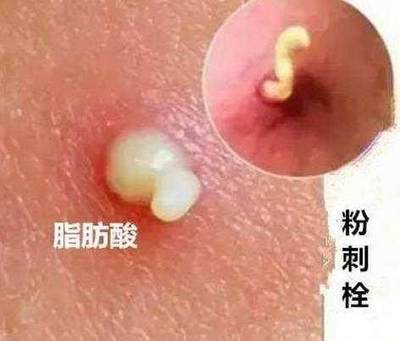 挤了痘痘该怎样消炎快