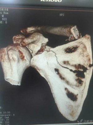 肩胛骨骨折怎么治疗