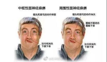 左脸发麻是怎么回事