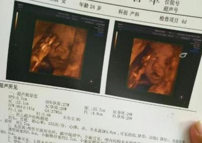 胎儿几个月发育听力