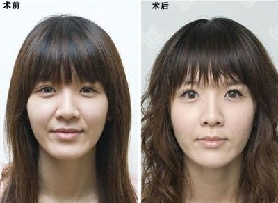 泰州四院做双眼皮如何