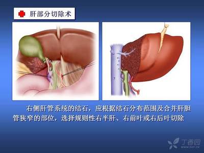 肝管结石怎么治疗最好的方法