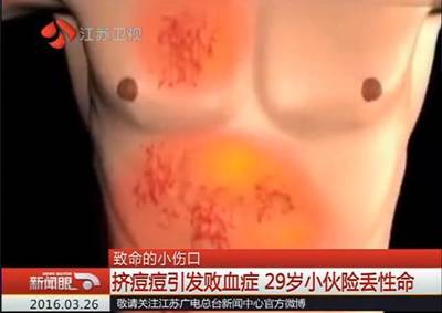 嘴唇边上长痘痘肿了