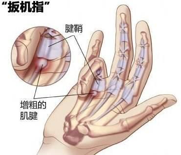 什么是腱鞘炎怎么治疗