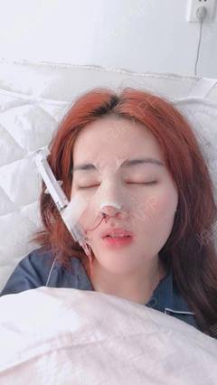 哪里自体隆鼻效果好