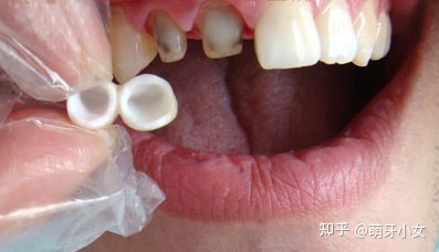 烤瓷牙和全瓷牙哪种好