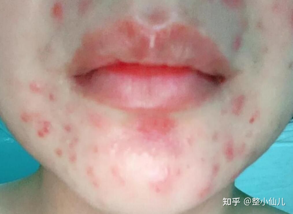 嘴巴上面的痘痘疼