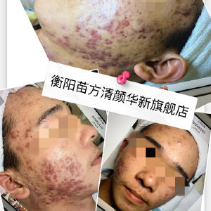 衡阳哪里治痘痘好