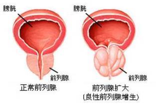 看前列腺肥大要多少钱