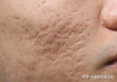起痘痘可以做微针吗