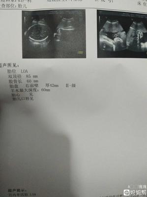 胎儿七个月双顶径标准