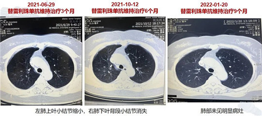 双肺小结节怎么治疗
