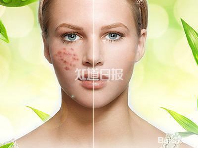 什么牙膏去痘痘最好
