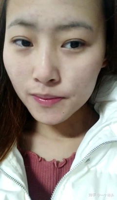 脸蛋两侧长痘痘怎么办