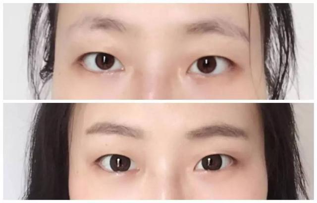 桃花眼必须是双眼皮吗