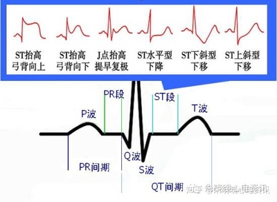 左室高电压是怎么回事