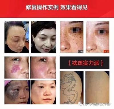 皮秒有痘痘可以做吗